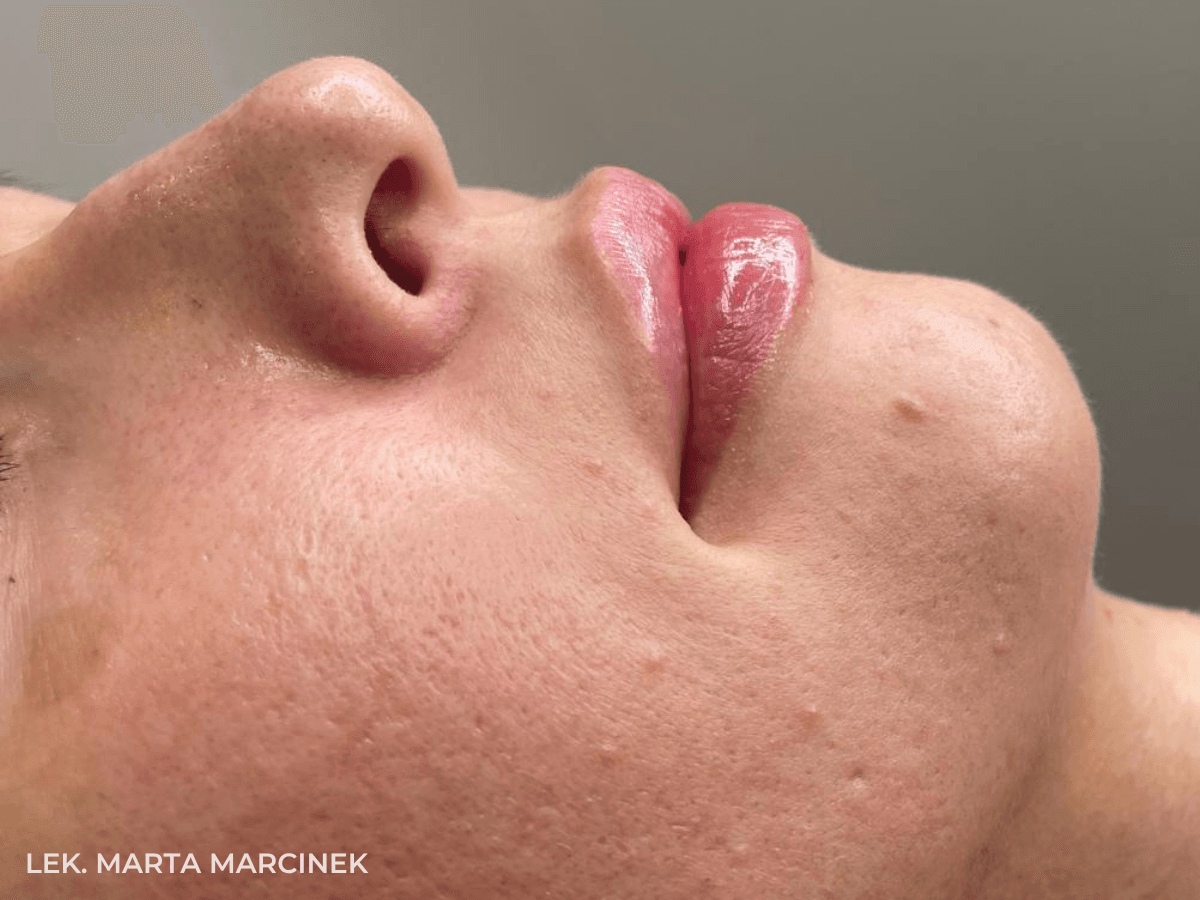 powiekszone usta krakow