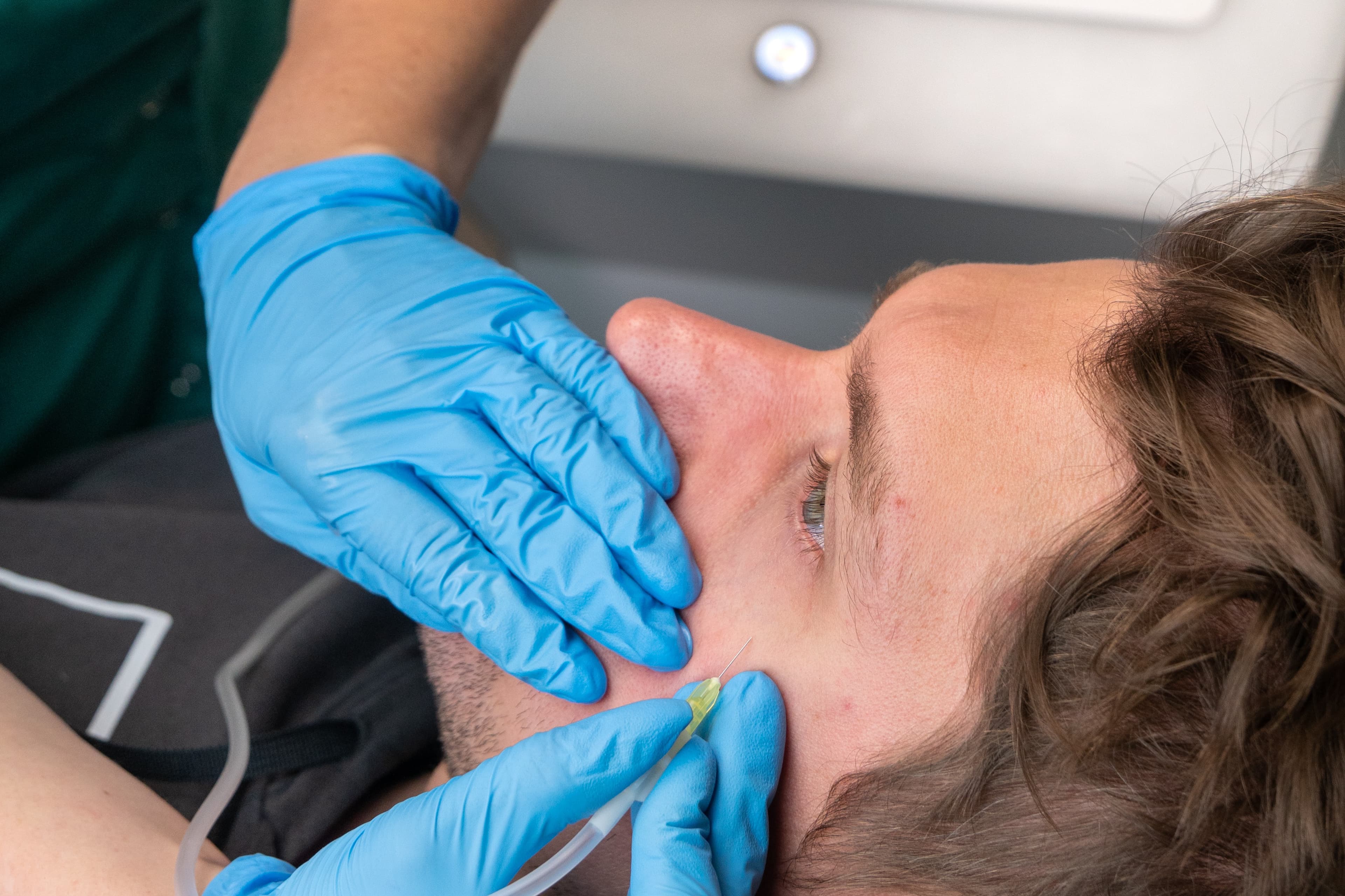 zabieg karboksyterapii pod oczy na pacjencie