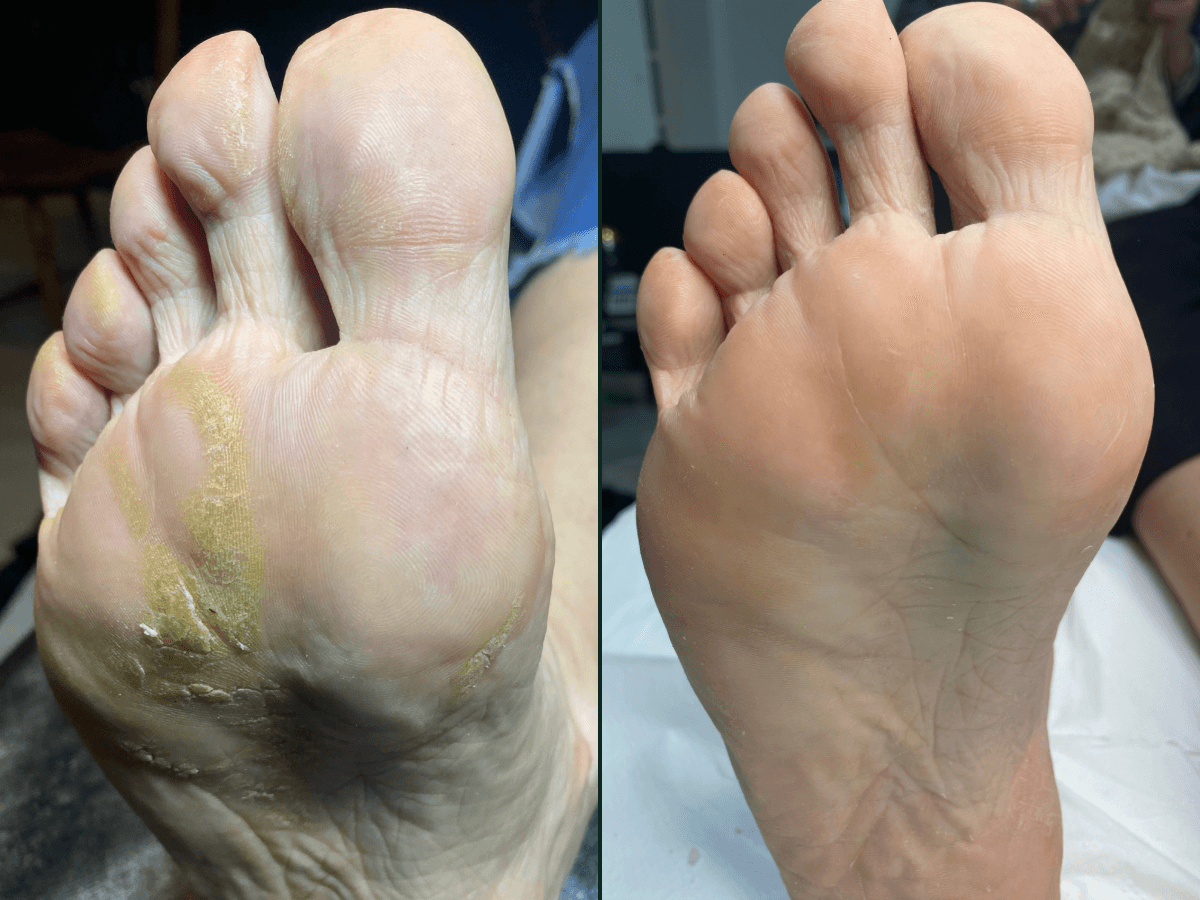 Efekt zabiegu Pedicure podologiczny wykonywanego przed podologa w health and beauty Kraków