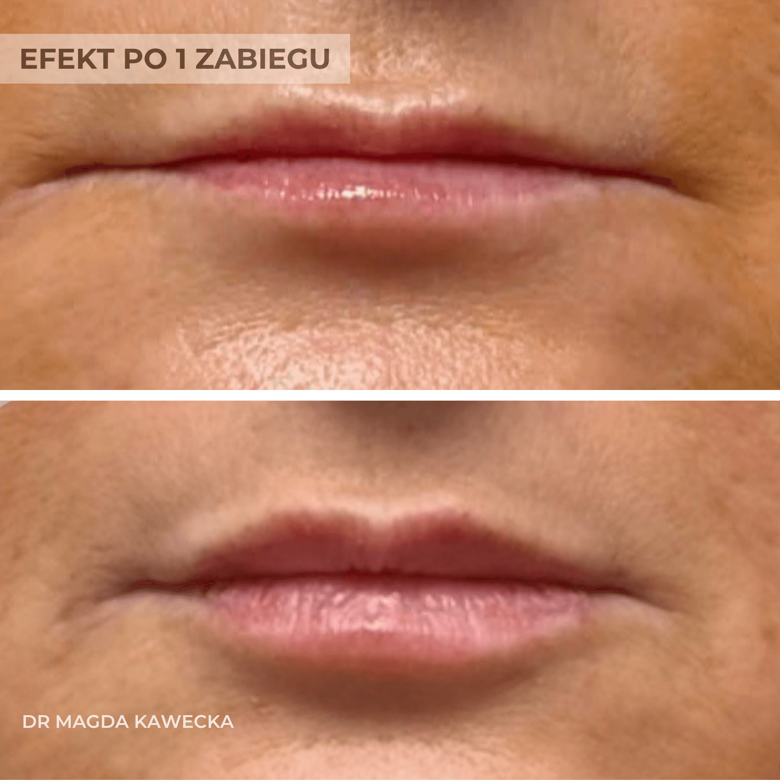efekt zabiegu przed i po modelowania ust
