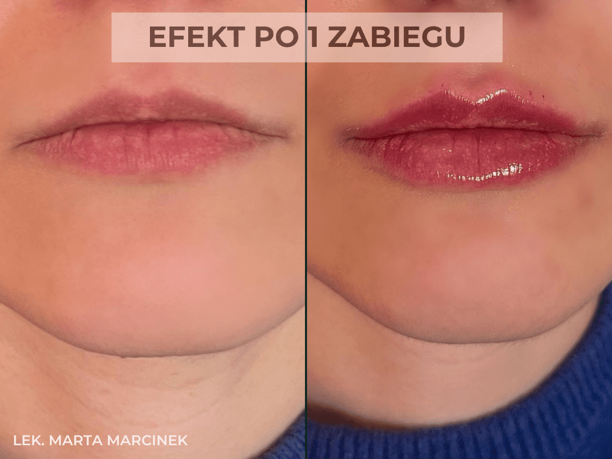 efekt zabiegu przed i po modelowania ust