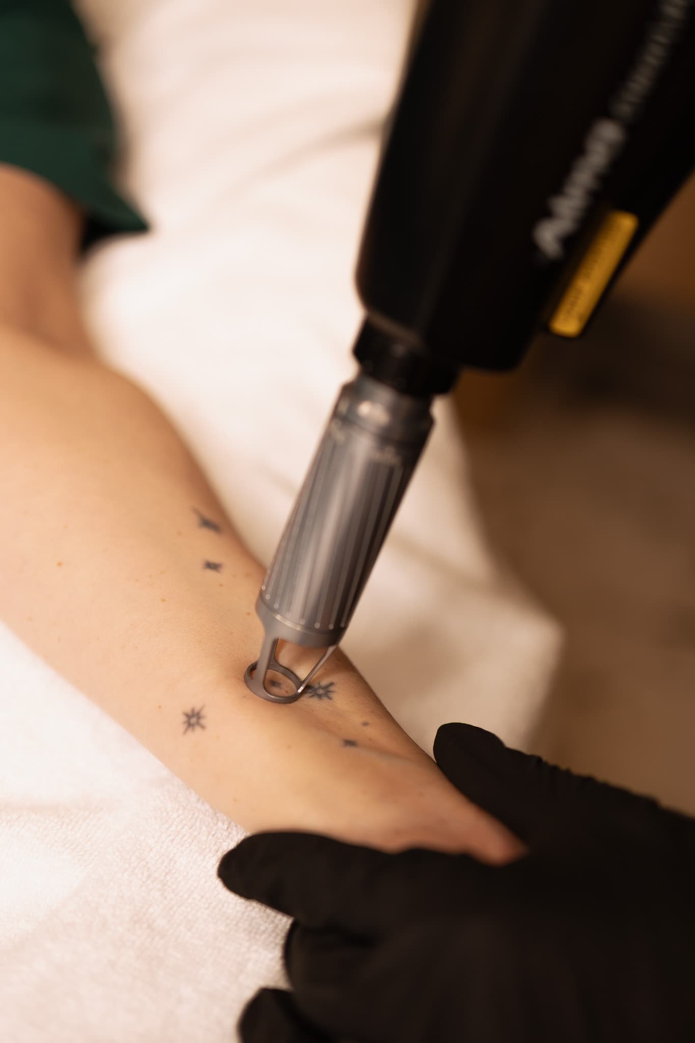 laserowe usuwanie tatuazu w krakowie