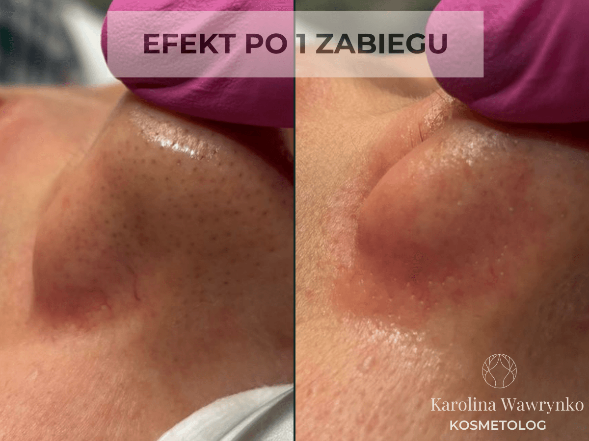 efekt zamykania naczynek laserem w krakowie