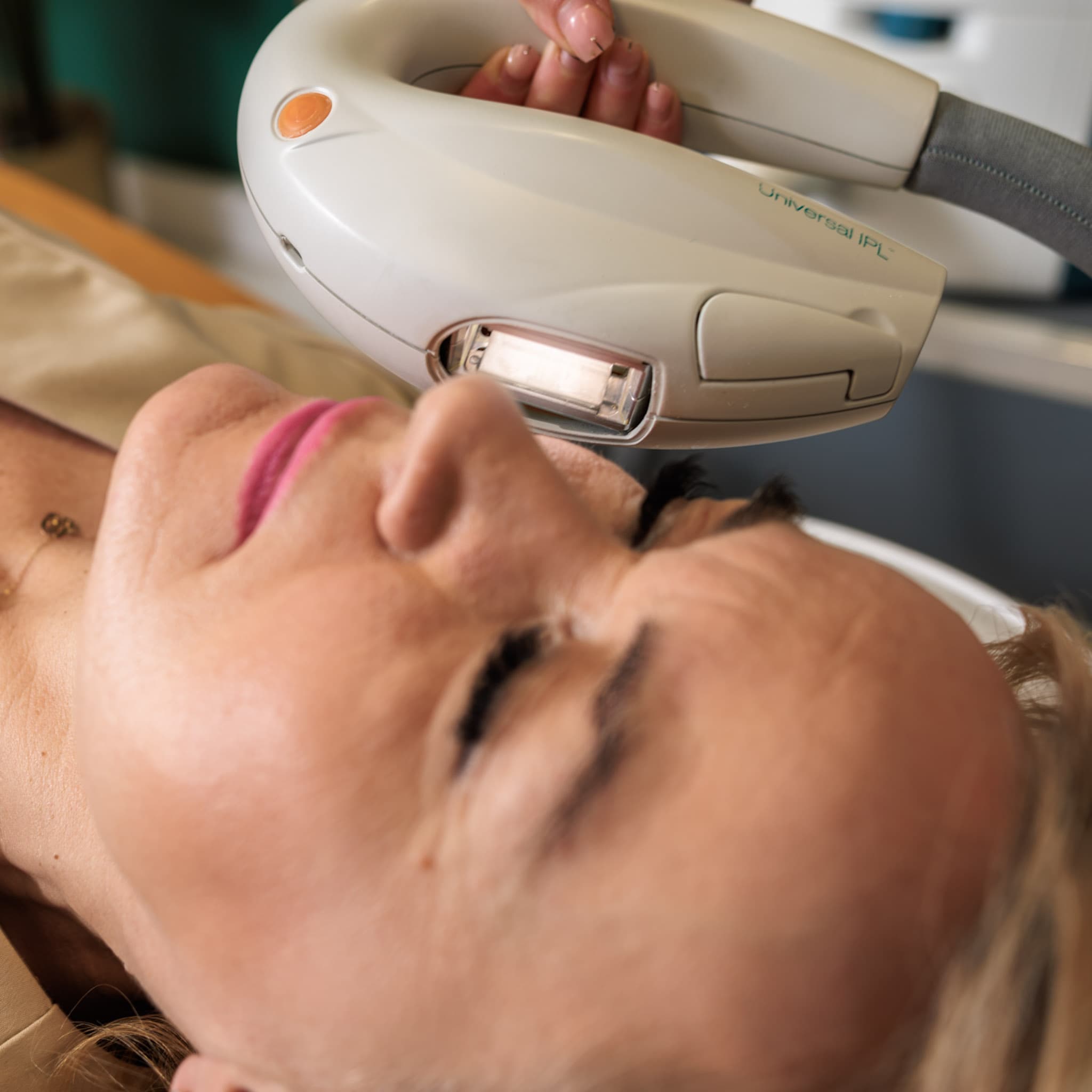 laserowe zamykanie naczynek w salonie kosmetycznym health and beauty w Krakowie