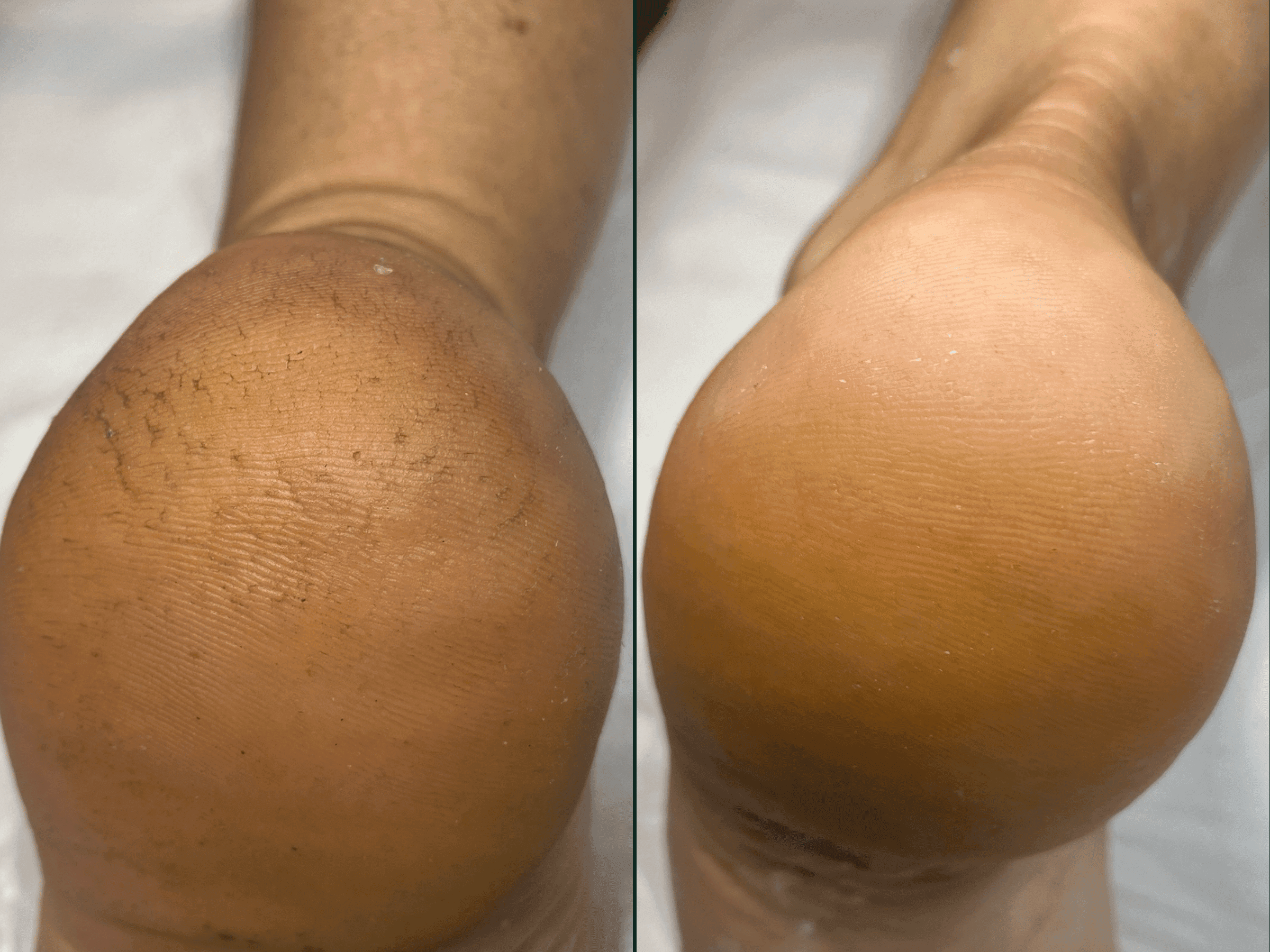 Tył stopy przed i po pedicure podologicznym w Health and beauty Kraków