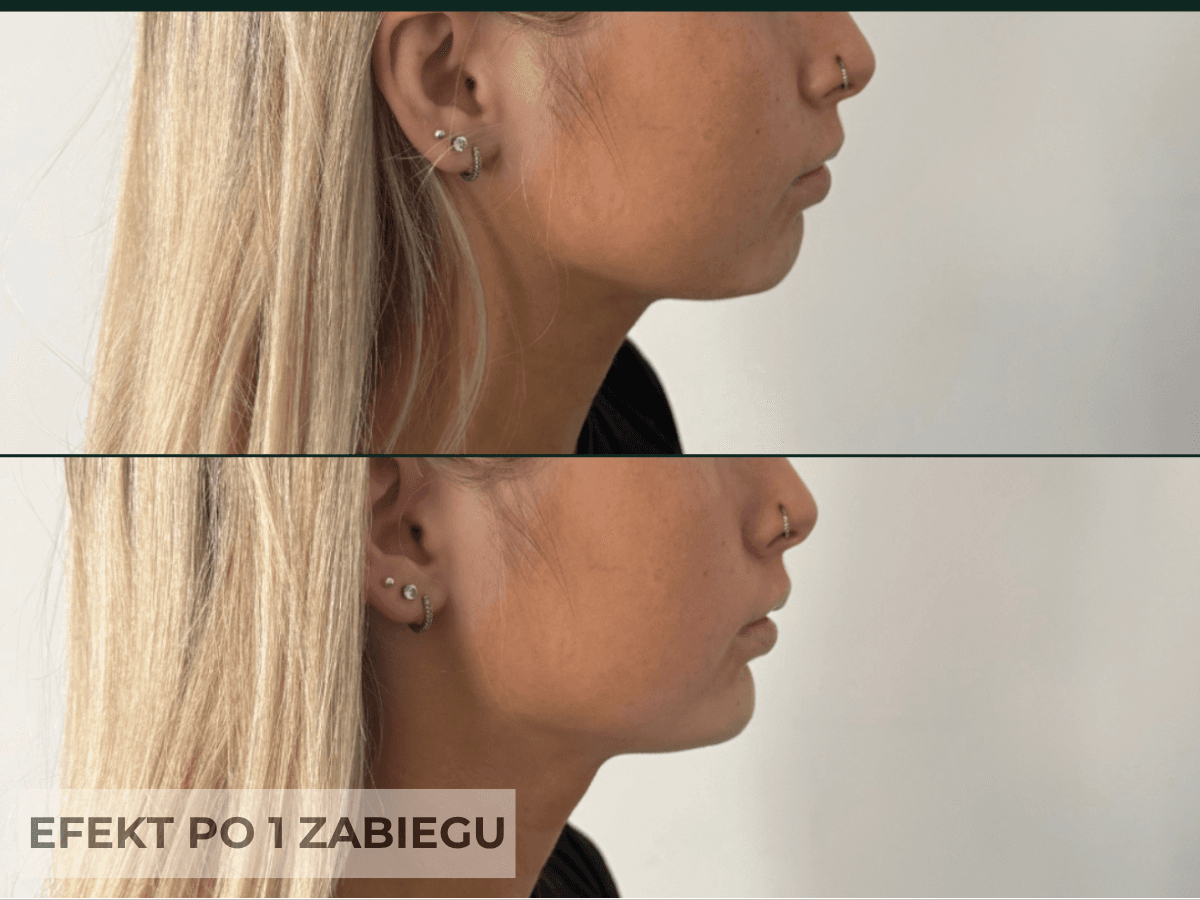 wolumetria twarzy efekt