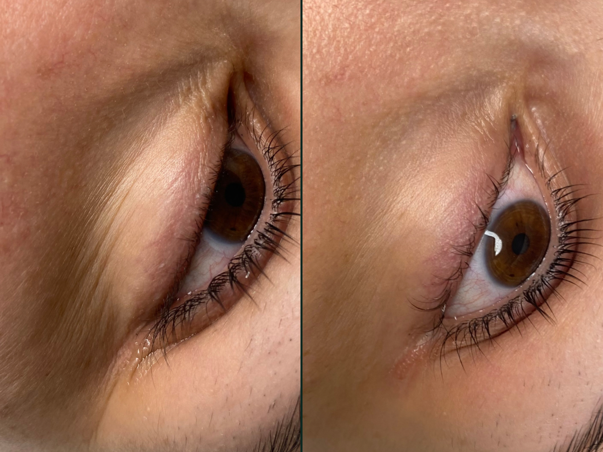 Mezoterapia igłowa pod oczy efekt przed i po