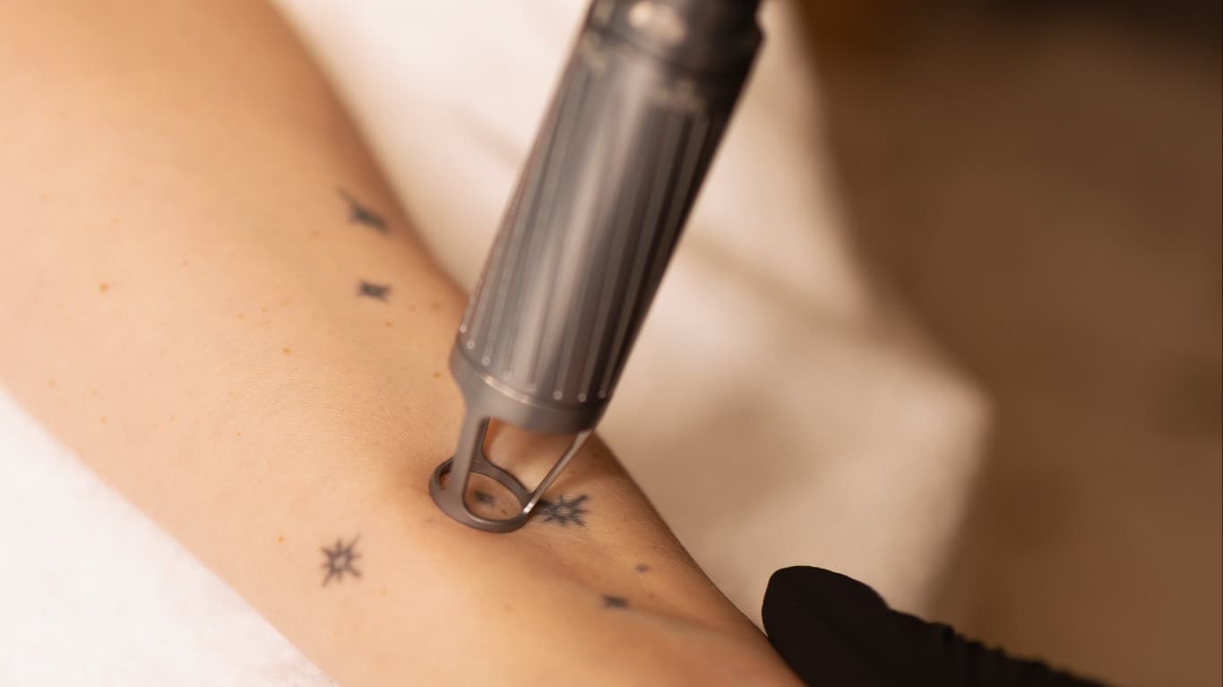 laserowe usuwanie tatuazu
