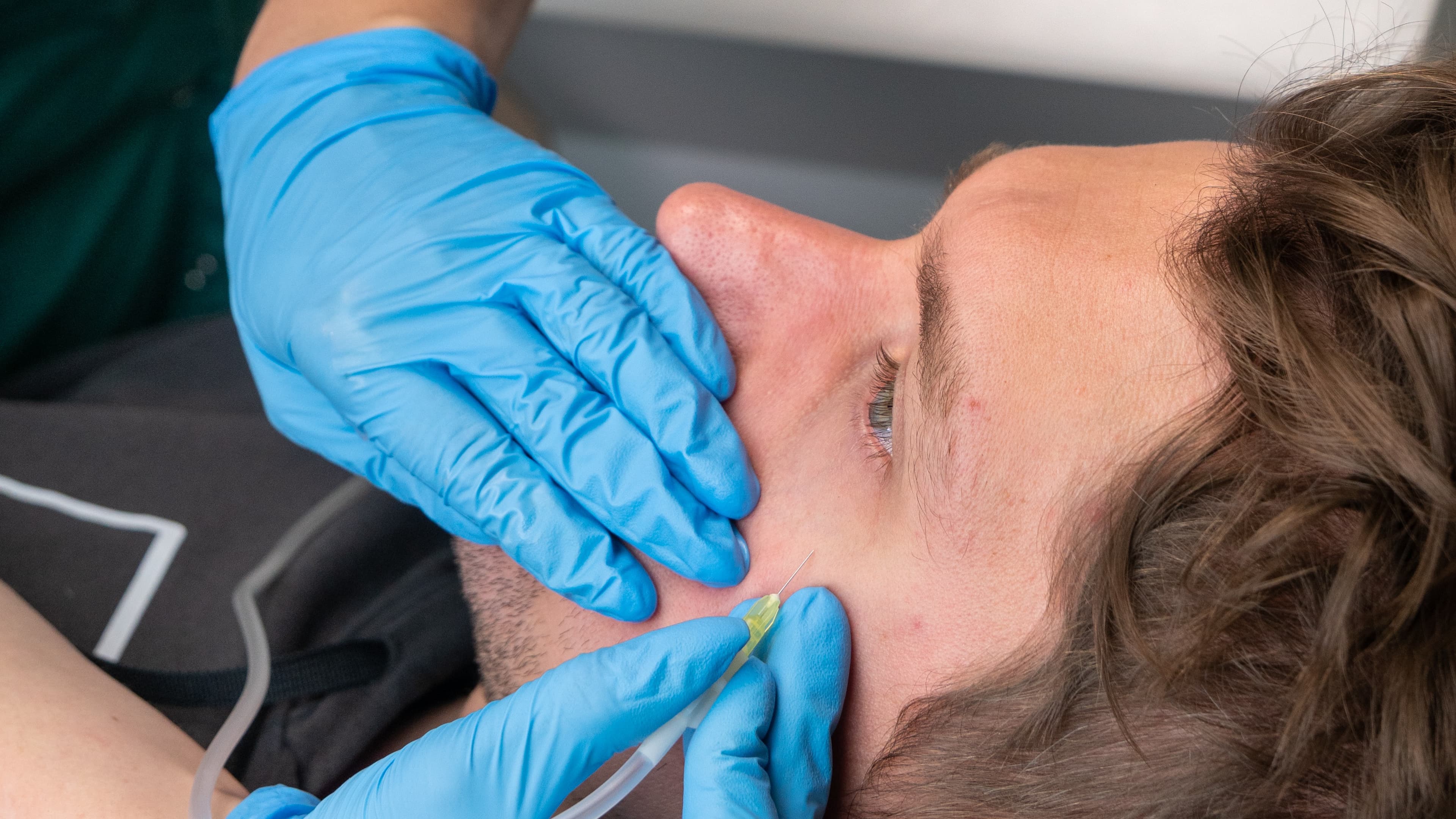 zabieg karboksyterapii pod oczy na pacjencie