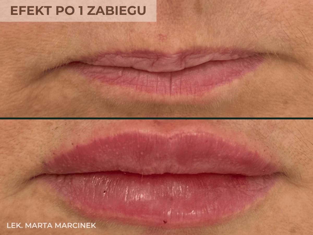 efekt przed i po powiekszaniu ust przez lekarza medycyny estetycznej