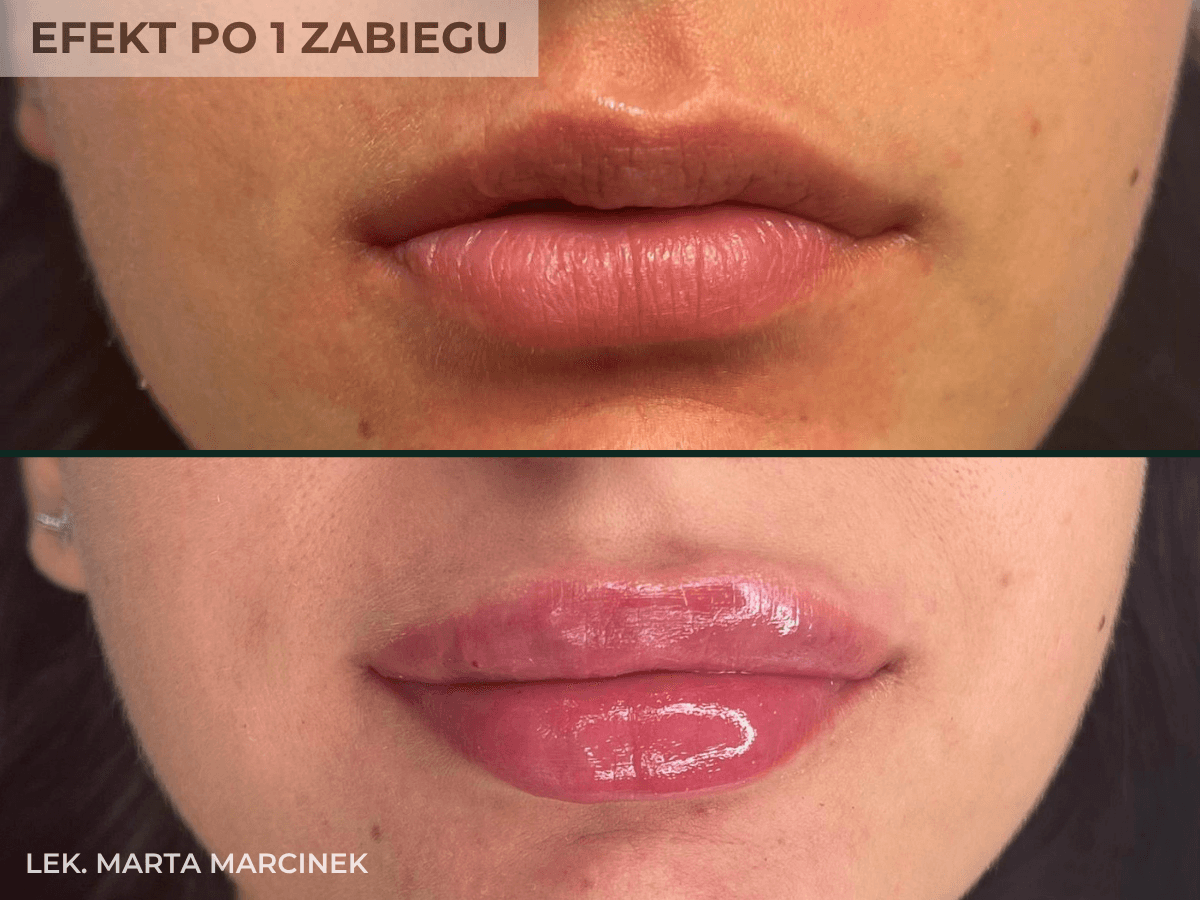 powiekszanie ust krakow efekt