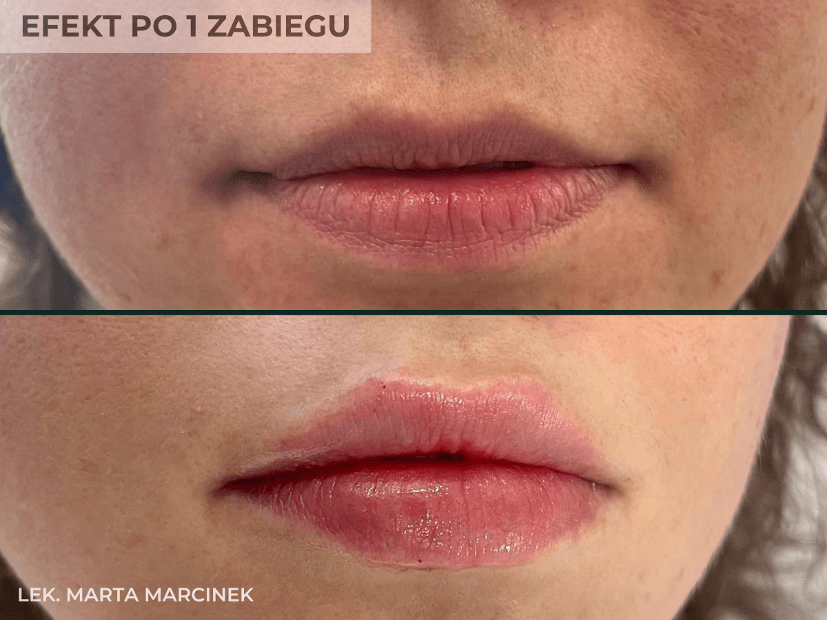 efekt powiekszania ust przez lekarza