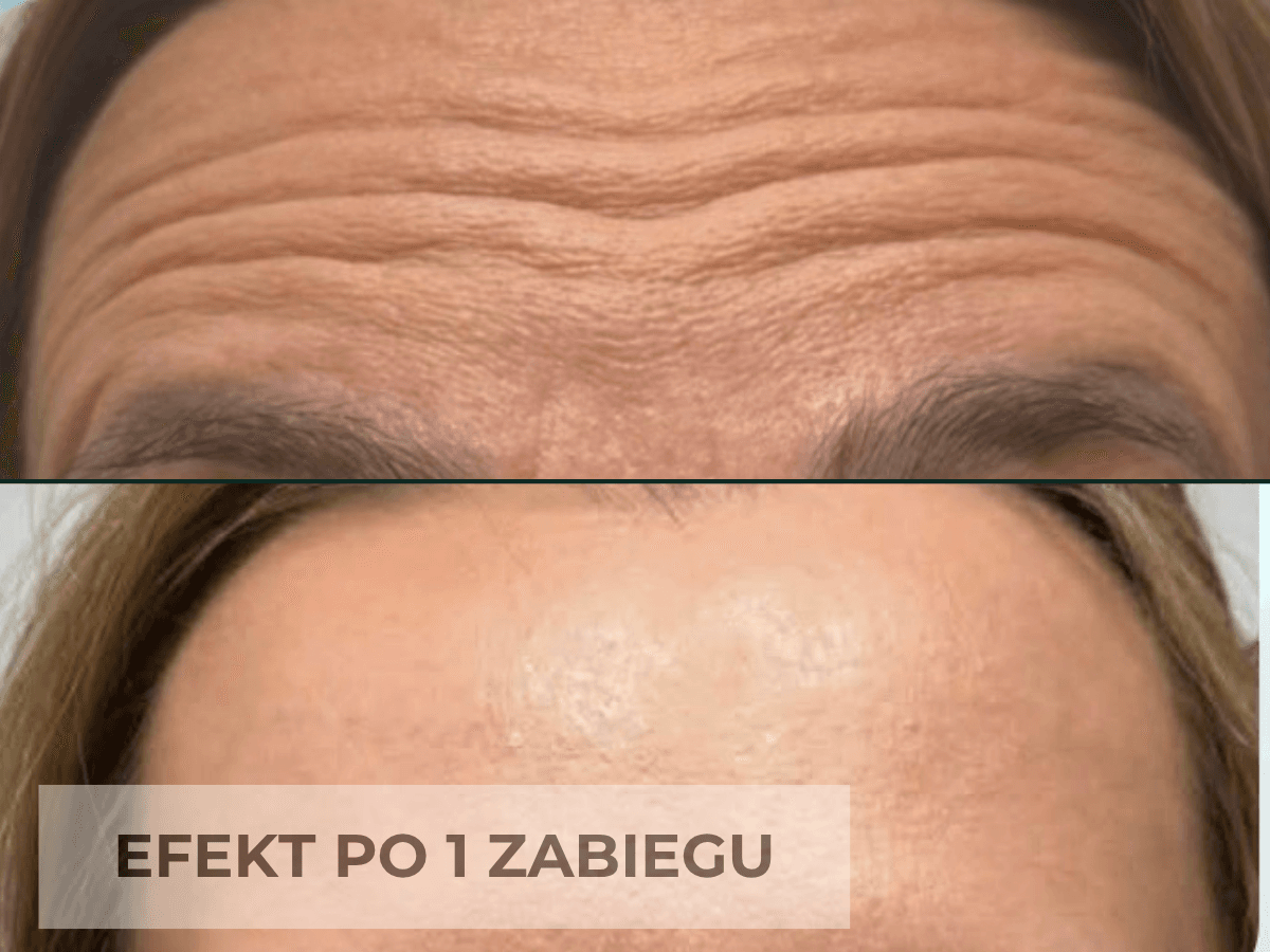 toksyna botulinowa na zmarszczki poprzeczne