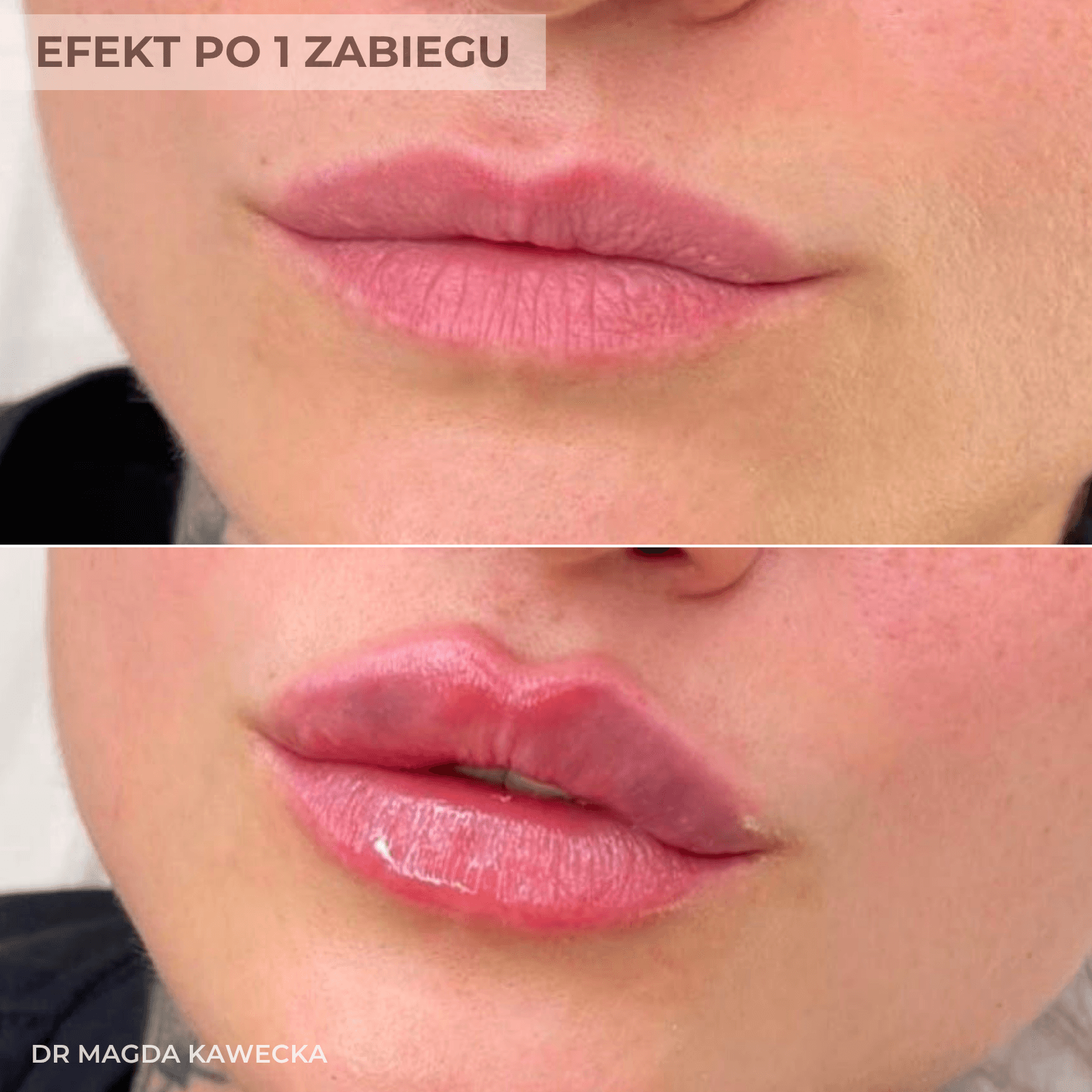 efekt powiekszanie ust na plasko w krakowie