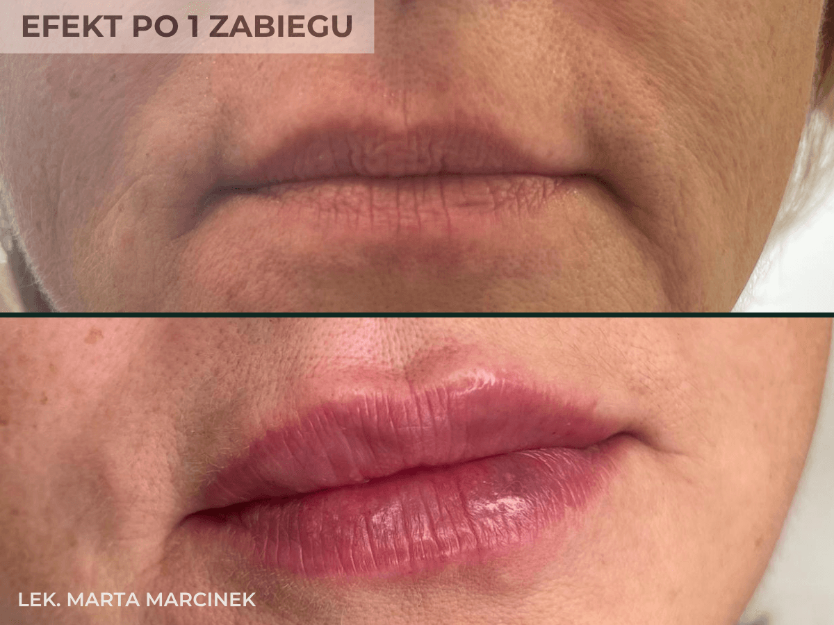 efekt przed i po jednym zabiegu powiekszaniu ust przez lekarza