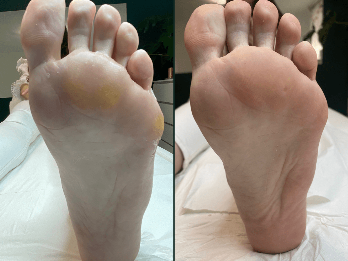 Stopa przed i po Pedicure podologicznym w Krakowie