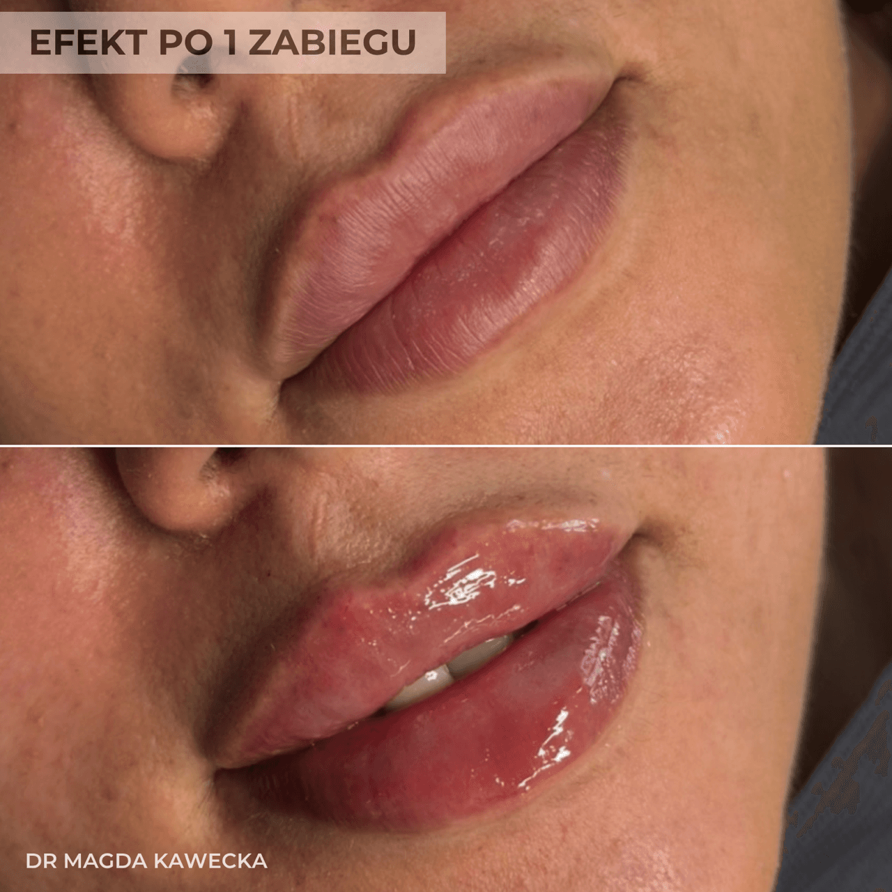 efekt przed i po powiekszaniu ust przez lekarza