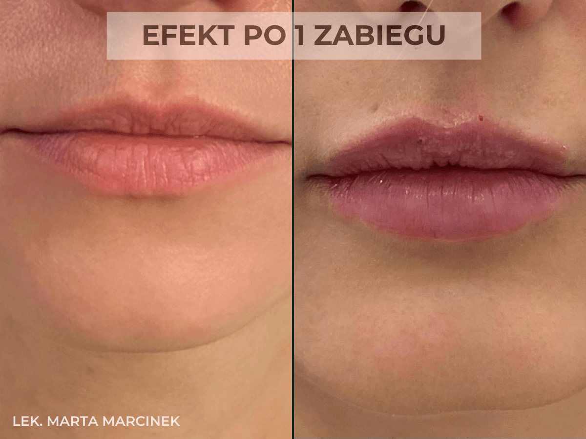 efekt przed i po powiekszaniu ust przez lekarza