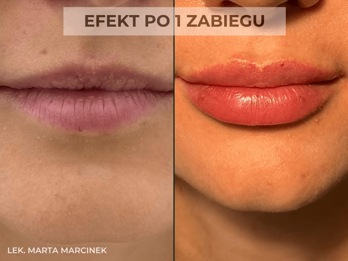 efekt przed i po modelowaniu ust przez lekarza