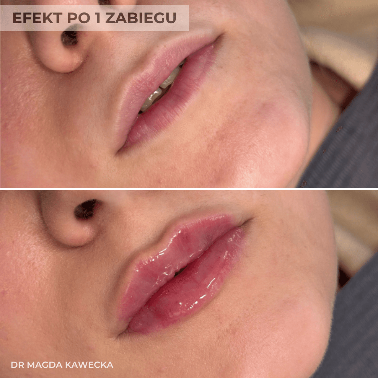 efekt przed i po modelowaniu ust przez lekarza