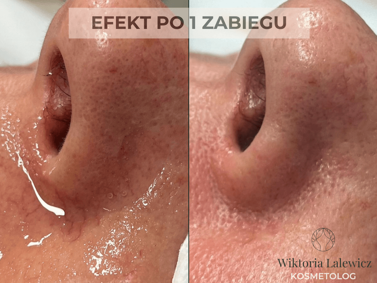 efekt zamykania naczynek na nosie przed i po w health and beauty w krakowie