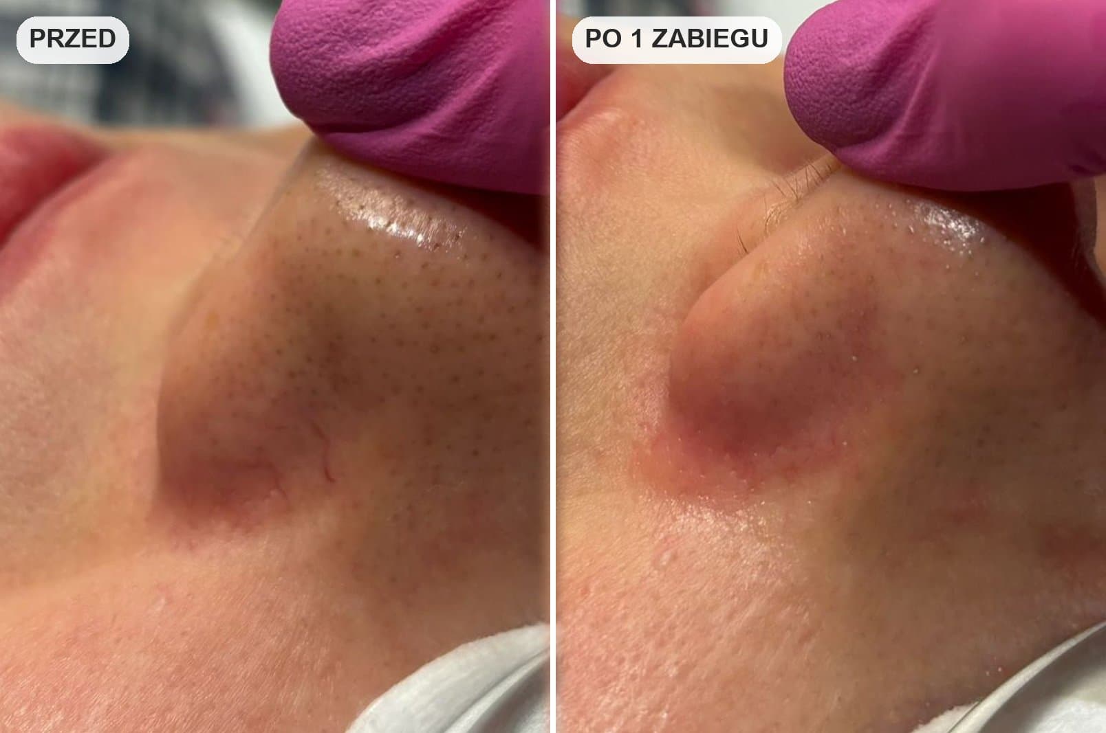 popękane naczynka przy nosie przed i po zabiegu laserem w krakowie