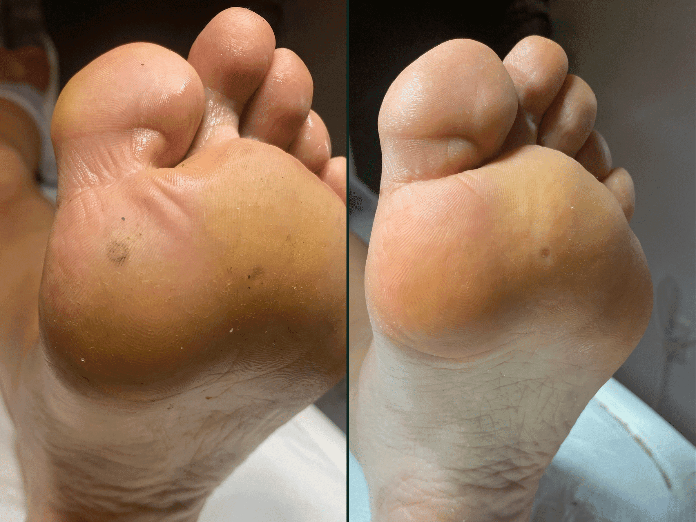 Efekt zabiegu pedicure podologiczny na stopach zrobiony w salonie Health and beauty Kraków