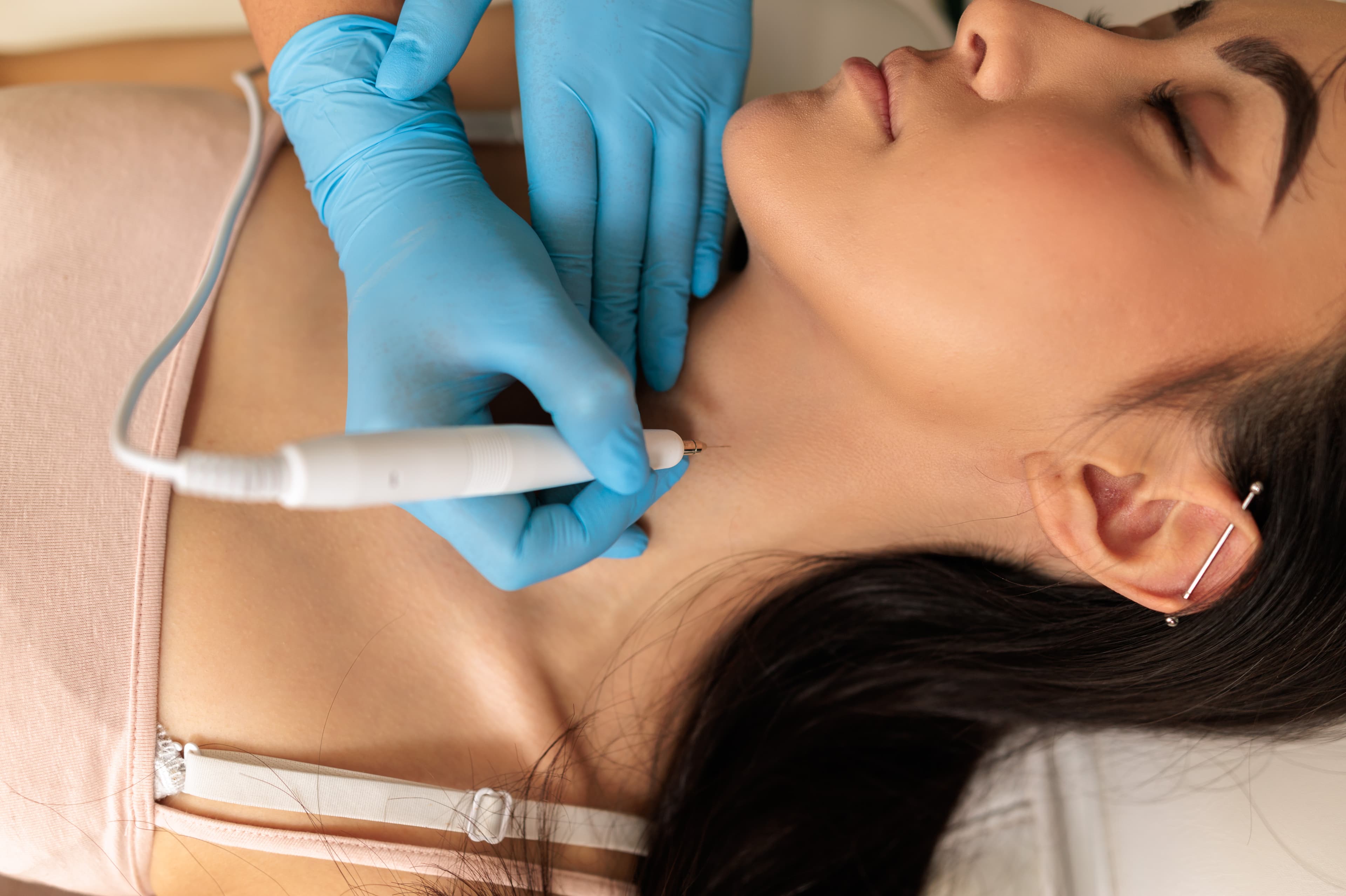 zbliżenie w trakcie zabiegu elektrokoagulacji w krakowie