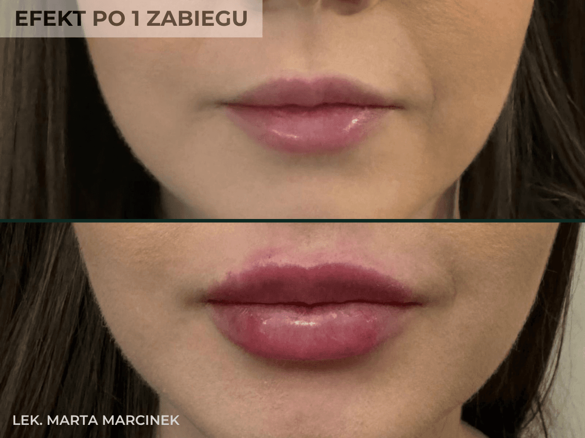 efekt przed i po powiekszaniu ust przez lekarza w krakowie
