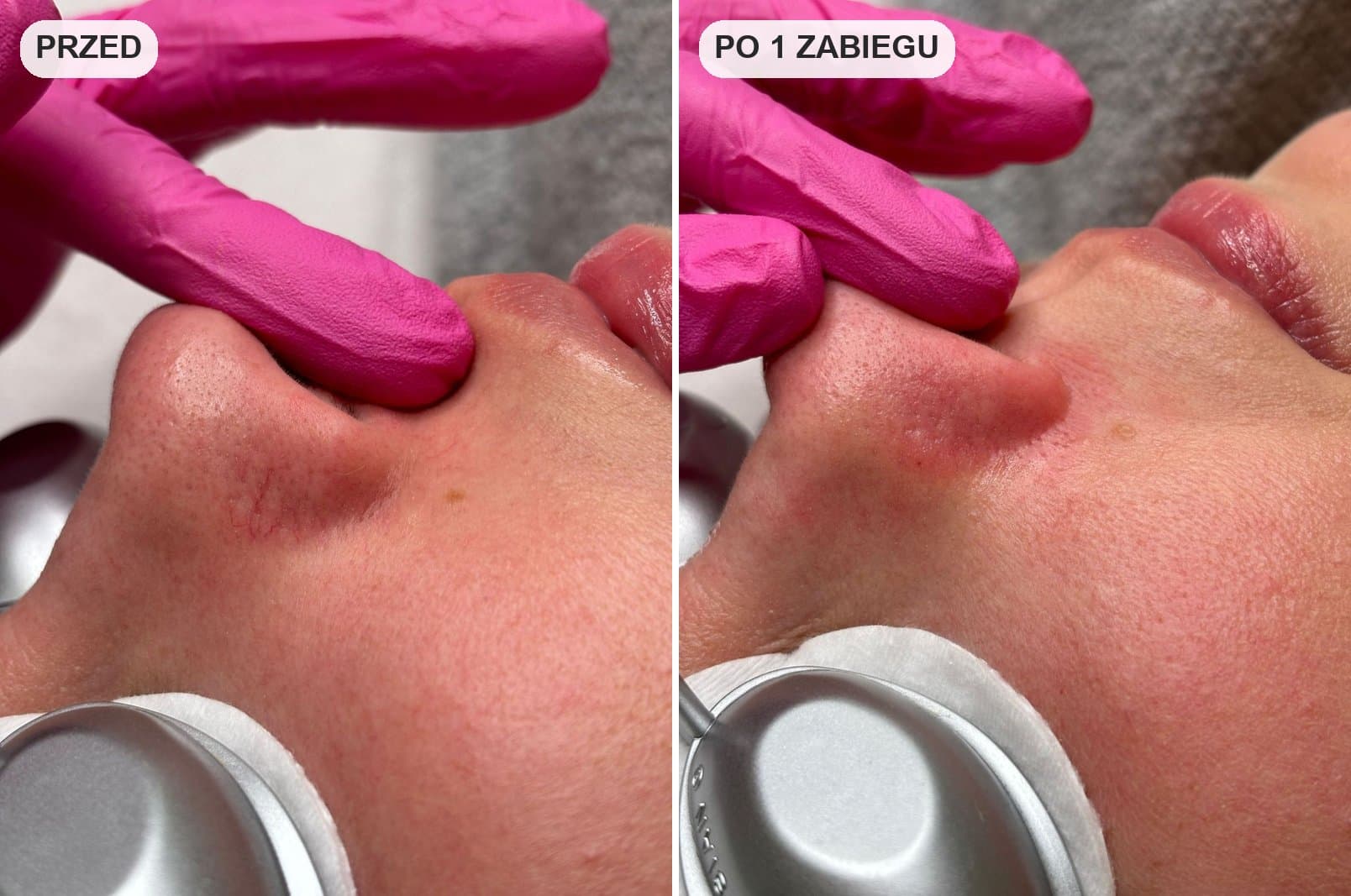 efekty zamykania naczynek laserem przed i po w salonie health and beauty w krakowie