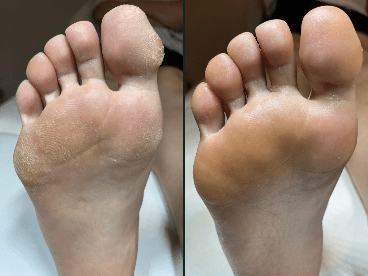 Efekt oczyszczenia stopy w trakcie pedicure podologiczny w Krakowie