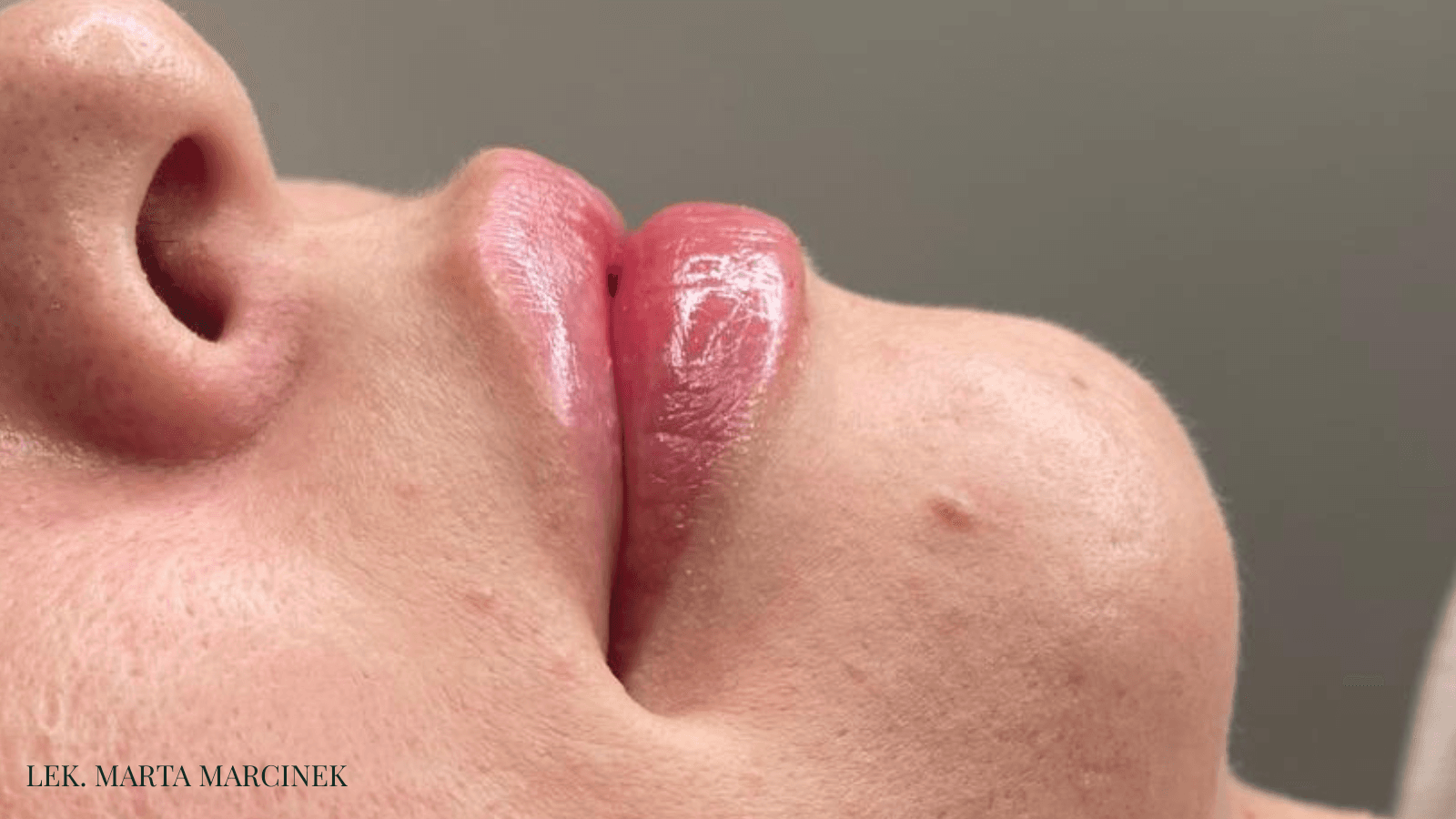 powiekszanie ust efekt