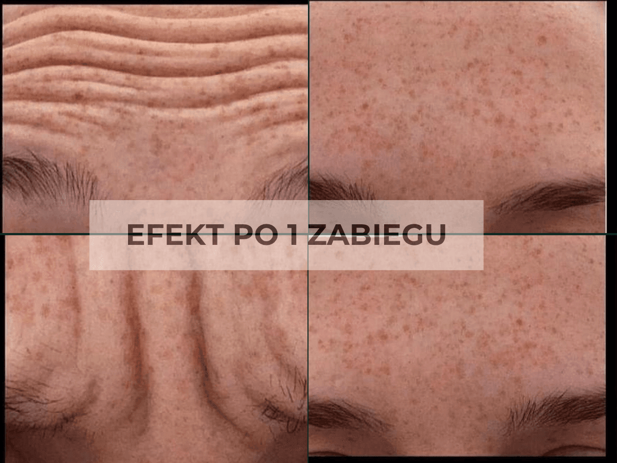 toksyna botulinowa na lwia zmarszczke na czole efekt
