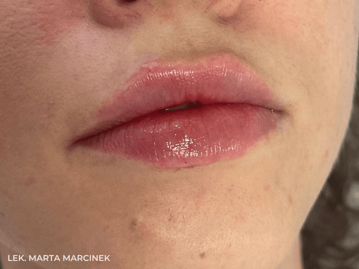 efekt modelowania ust krakow zabieg