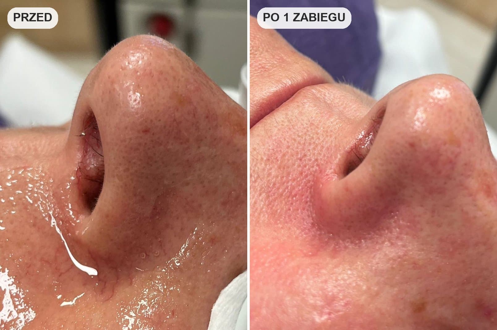 zamykanie naczynek na nosie przed i po zabiegu laserem w krakowie