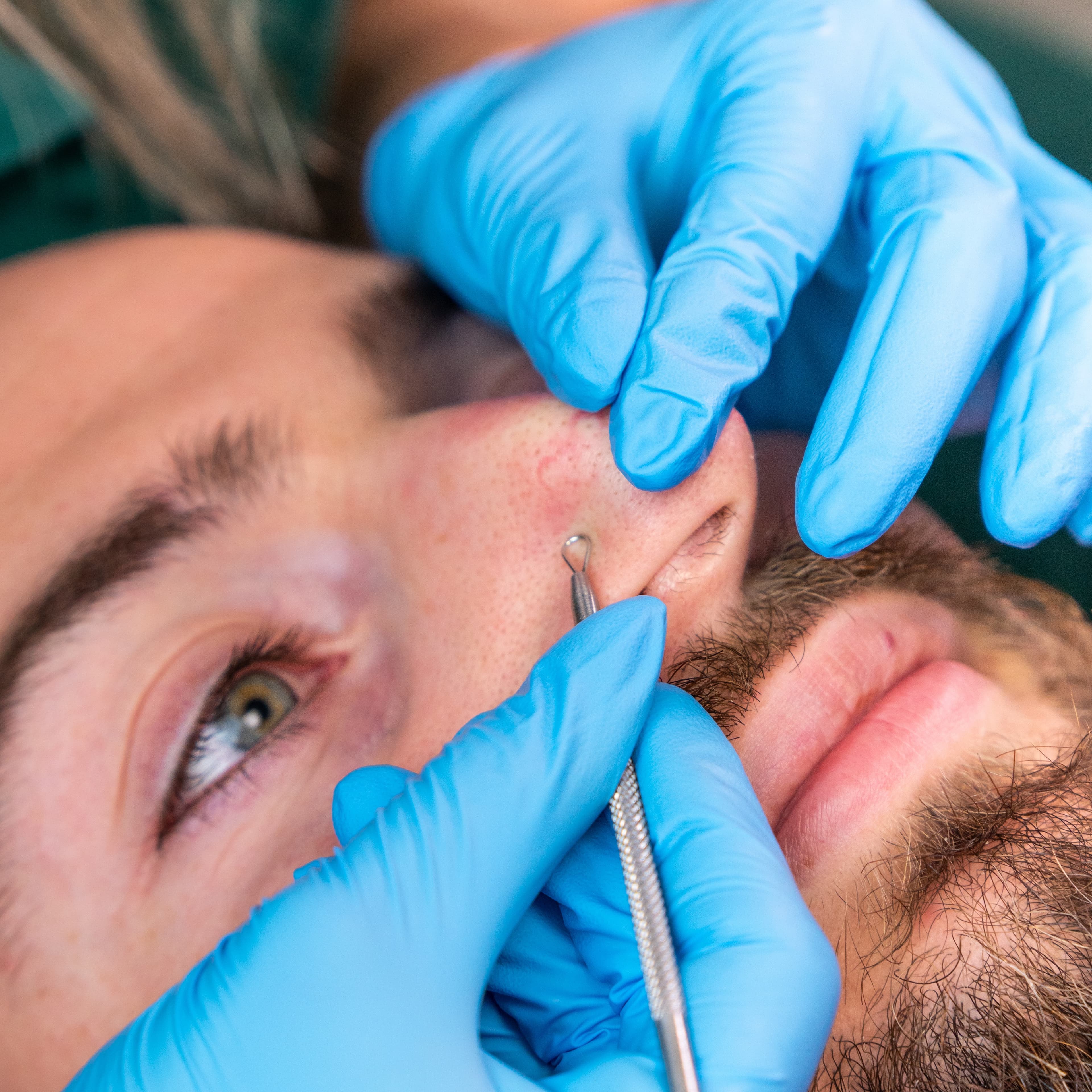 manualne oczyszczanie twarzy podczas zabiegu