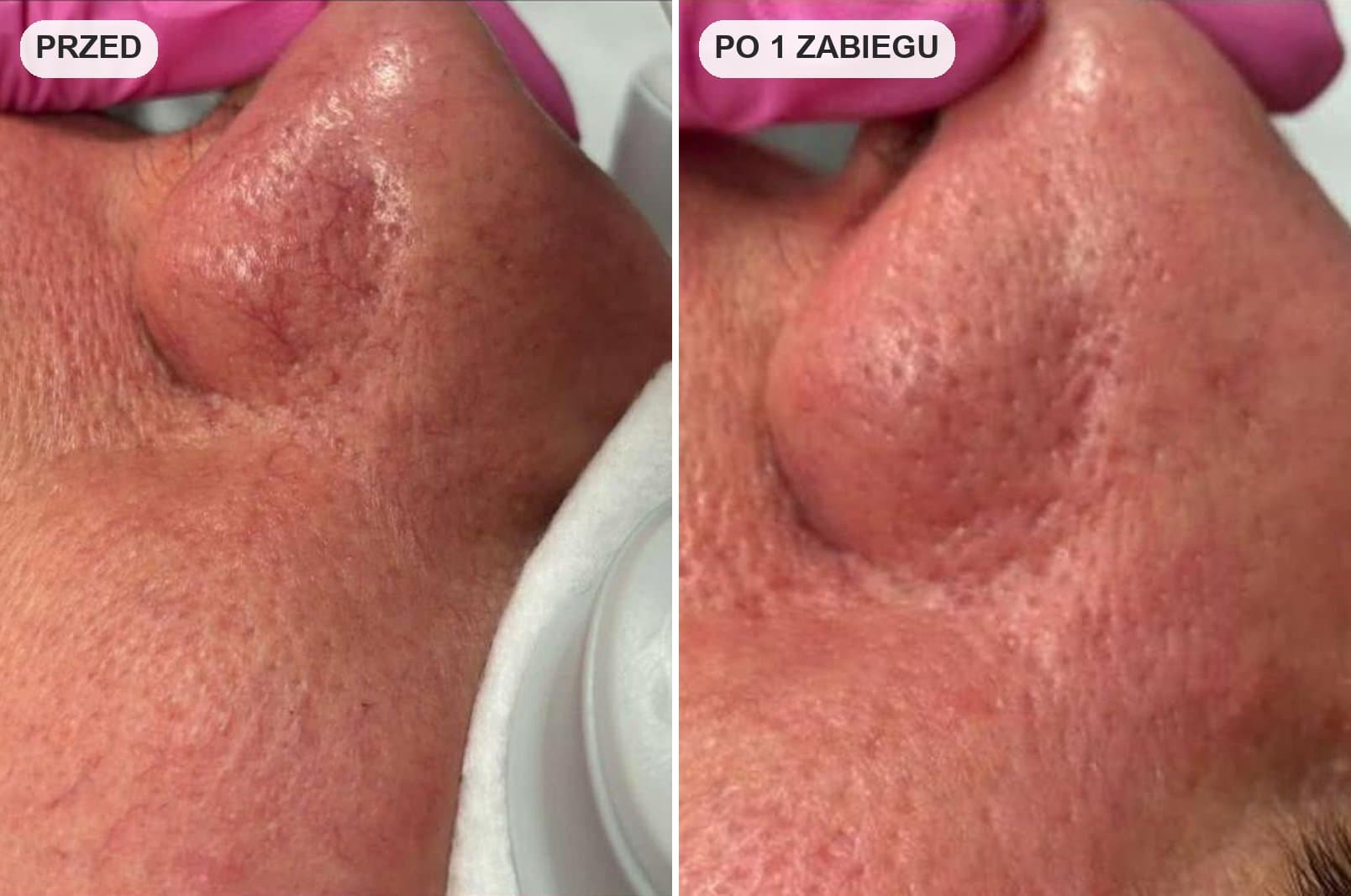 naczynka na skrzydełku nosa przed i po laserowym zamykaniu naczynek w krakowie
