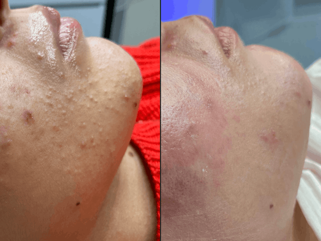 Efekt zabiegu przed i po Oczyszczanie wodorowe twarzy w Krakowie