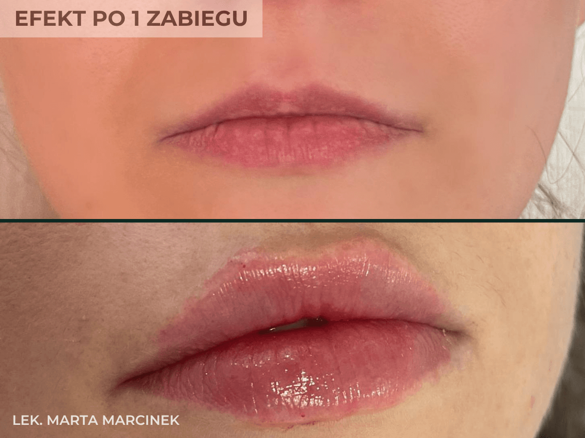 modelowanie ust kwasem hialuronowym w krakowie efekt